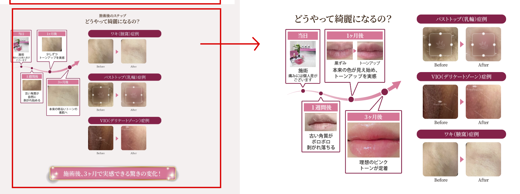 リップの施術経過。当日:施術(痛みには個人差がございます)。1週間後:古い角質がボロボロ剥がれ落ちる。1ヶ月後:本来の色が見え始め、トーンアップを実感。3ヶ月後:理想のピンクトーンが定着。