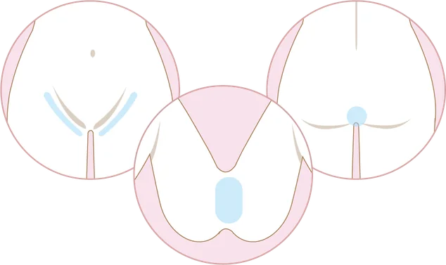 デリケートゾーン(VIO)の施術範囲