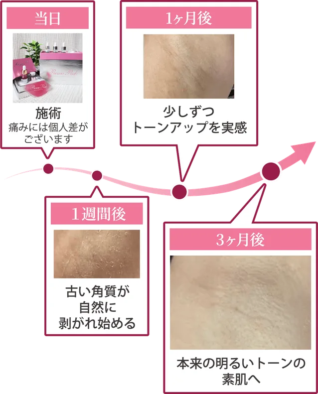 当日:施術(痛みには個人差がございます)→ 1週間後:古い角質が自然に剥がれ始める → 1ヶ月後:少しずつトーンアップを実感 → 3ヶ月後:本来の明るいトーンの素肌へ
