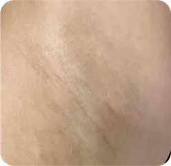 ワキ(腋窩)施術前