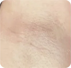 ワキ(腋窩)施術後