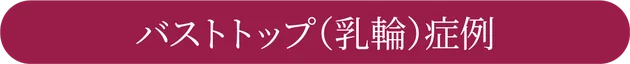 バストトップ(乳輪)症例